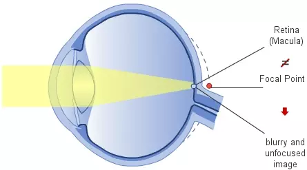 Farsightedness