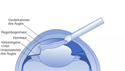 Die Hinterkammerlinse wird in der Regel ins Auge injiziert und entfaltet sich dort