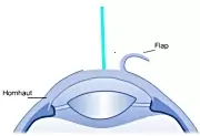 Femto-LASIK: Der Excimer Laser trägt Hornhautgewebe ab