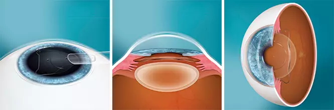 Kontaktlinse im Auge: Phake Linsen