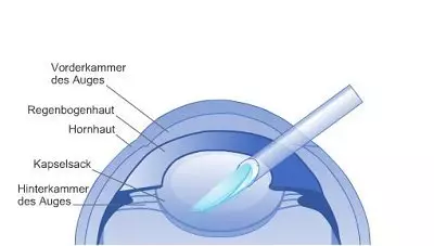 Linsenimplantation: Die Kunstlinse wird in das Auge injiziert und entfaltet sich 
