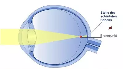 Fehlsichtigkeit: Bei Bei Kurzsichtigkeit ist das Auge in der Regel zu lang